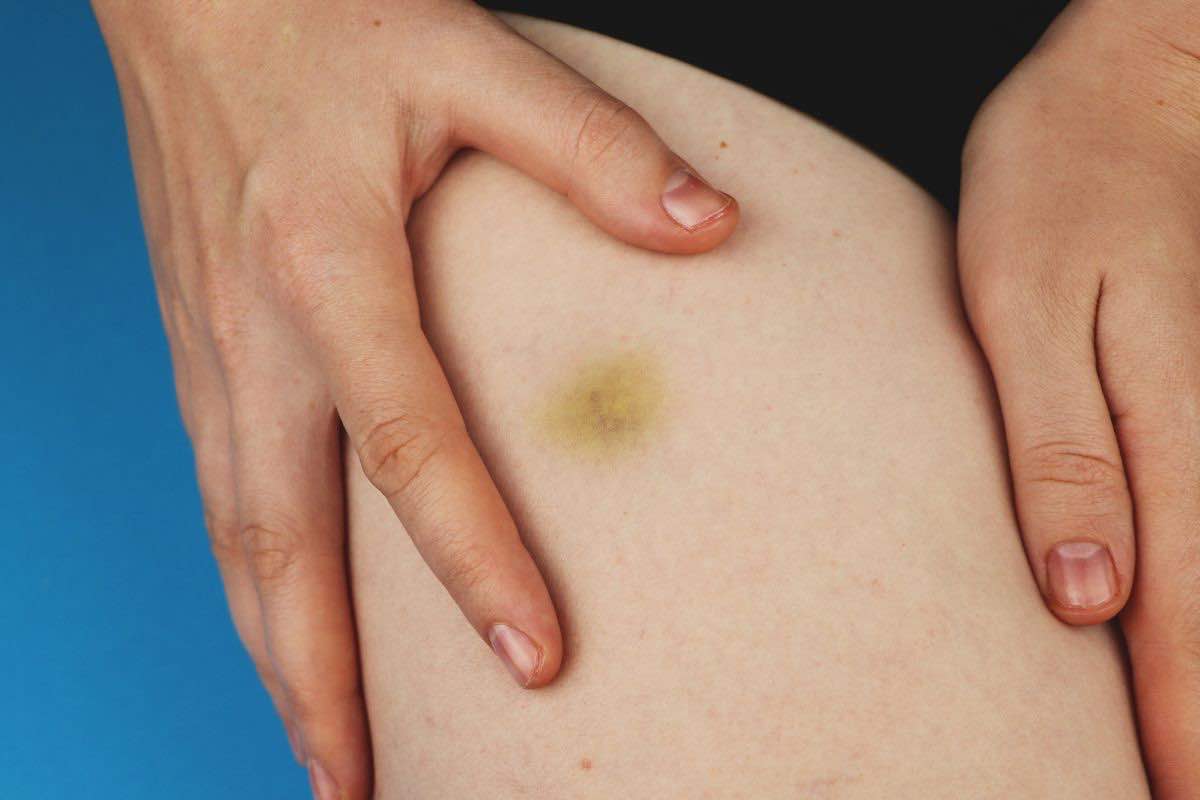 Lipedema