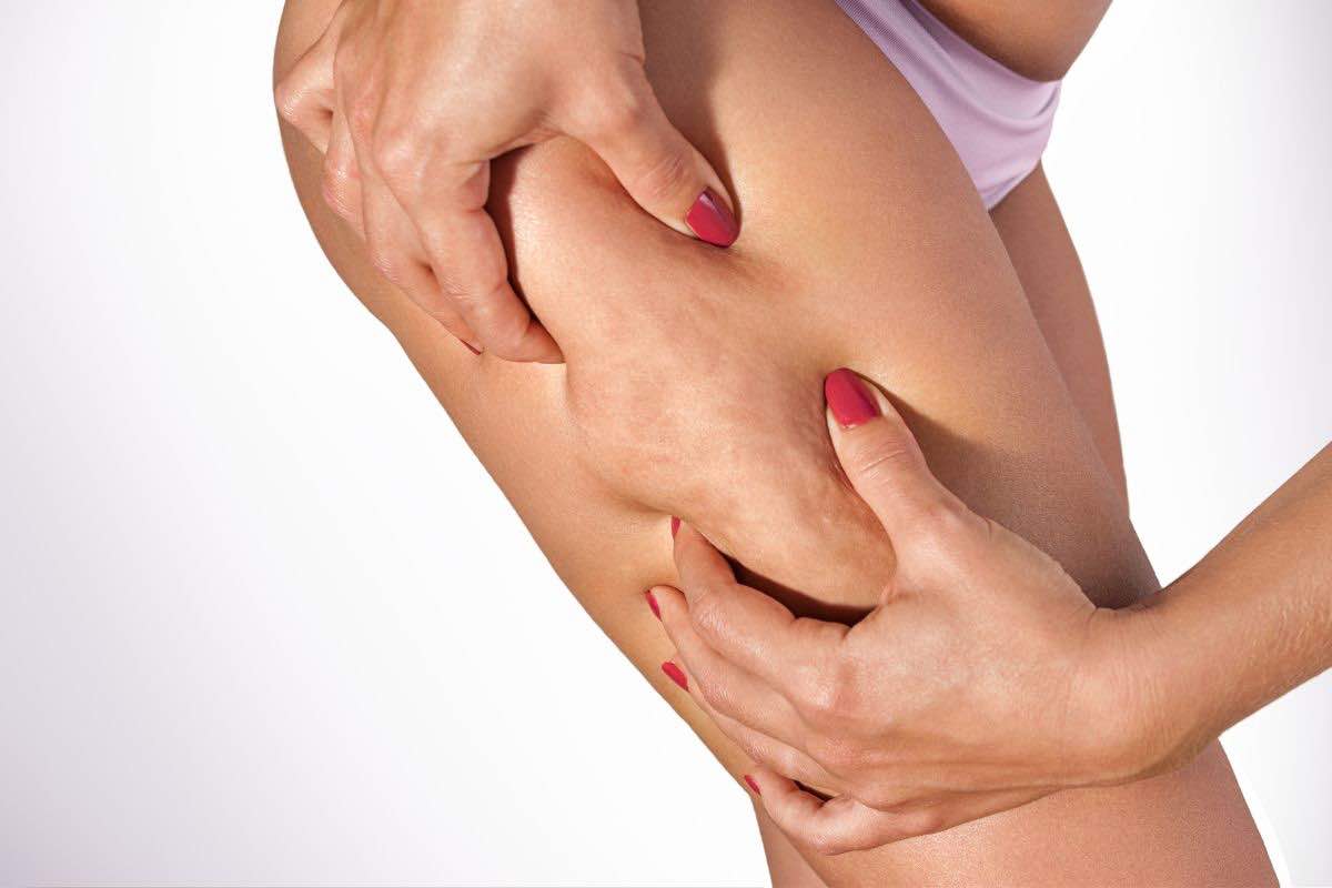 Cellulite